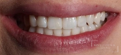 After