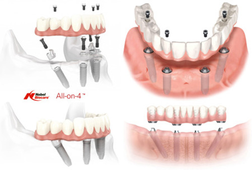 Dental Implants