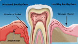 Bad Breath & Gum Disease