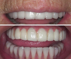 Dental Implants